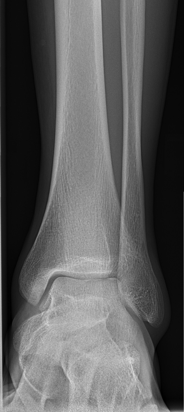 Röntgenbild eines menschlichen Beins mit einem gebrochenen Knöchel und detaillierter Knochen- und Bandstruktur.
