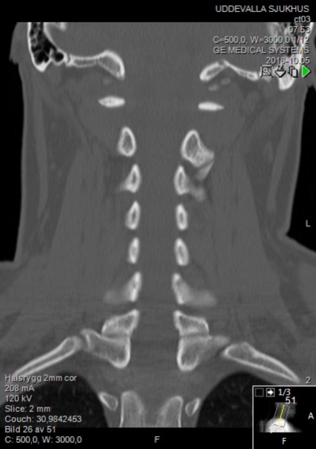 Eine MRT-Aufnahme eines Mannes mit einem Halsbruch, die auf einem Computerbildschirm angezeigt wird, zeigt die Größe, Form und Lage des Bruchs.