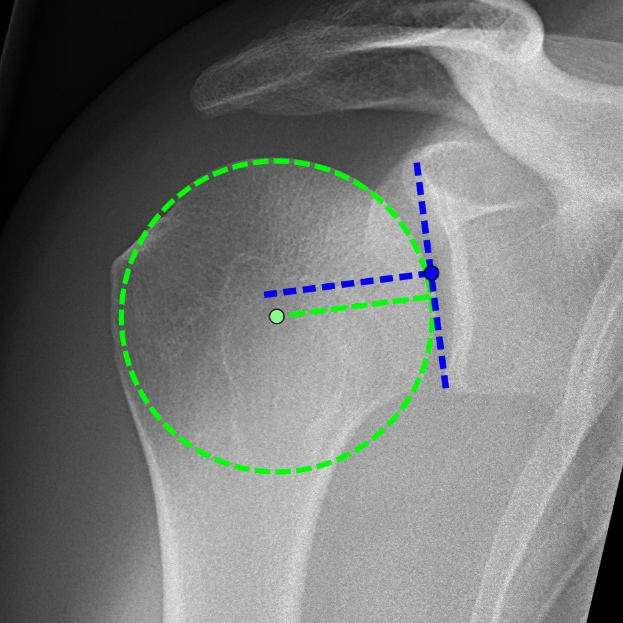 Ein Röntgenbild einer Schulter mit einem grünen Kreis, der die Lage eines Bandes markiert, umgeben von anderen Bändern.